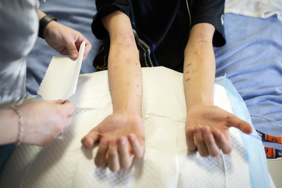 Steven Hom, 18, endures a skin test as part of a clinical trial that is designed to desensitize his immune system to his severe peanut allergy with an immunotherapy patch at El Camino Hospital in Mountain View, California on Tuesday, May 20, 2014. 