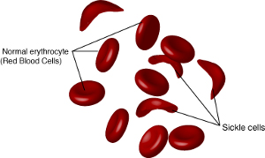 If we decide that changing human DNA is acceptable, then sickle cell anemia is an obvious candidate. (NHGRI)