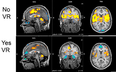 These images from an fMRI scan show areas of the brain affected by pain, and how they shrink when the patient is immersed in a virtual reality world. (Courtesy Dr. Sam Sharar/University of Washington)