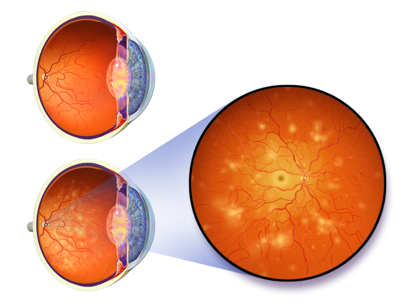An illustration depicting diabetic retinopathy
