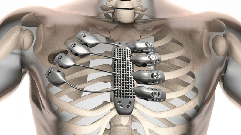 The implant was custom-designed using CT scans of a cancer patient's chest. The man lost his sternum and four ribs during surgery to remove a tumor.
