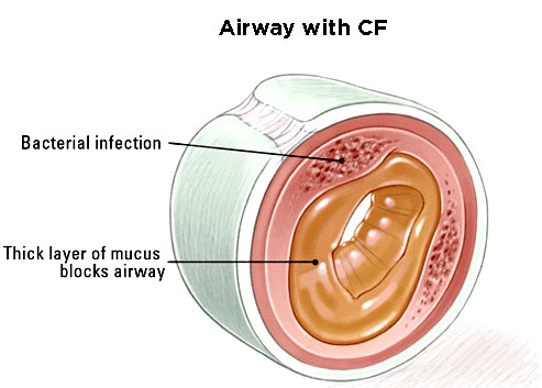 cystic fibrosis image