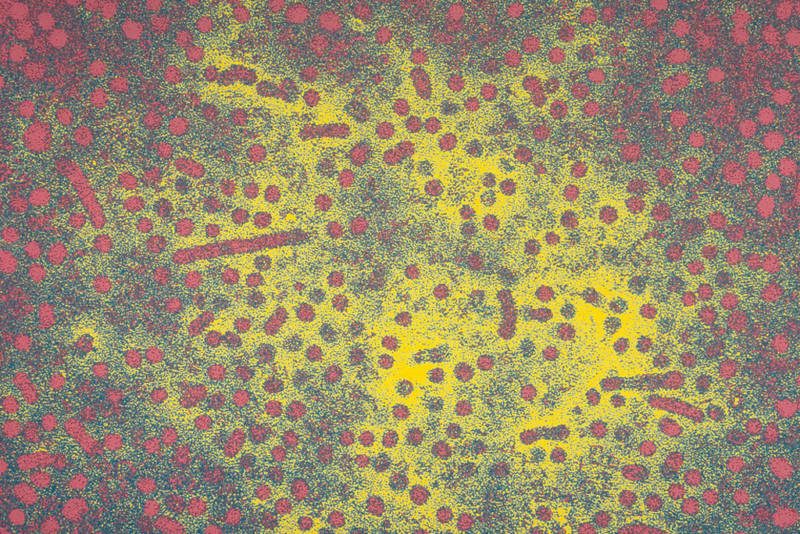 Electron microscope image of the hepatitis B virus (HBV). Hepatitis B causes inflammation of the liver and can cause both acute and chronic disease.