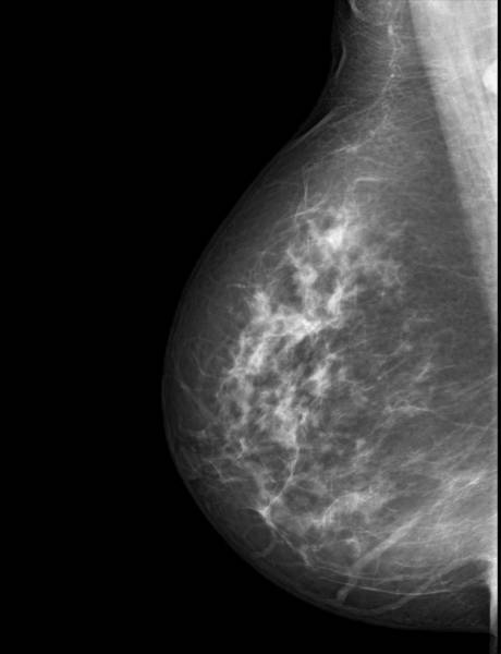A mammogram image.