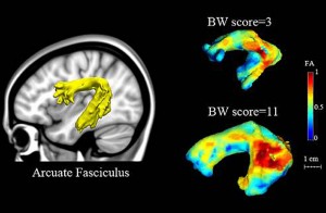 Researchers found that kindergarten children with strong pre-reading scores have a bigger, more robust and well-organized arcuate fasciculus (bottom right) while children with very low scores have a small and not particularly well-organized arcuate fasciculus (top right). (Zeynep Saygin/MIT)