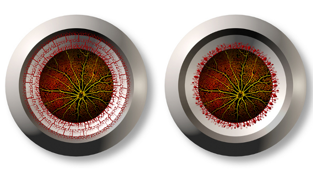 Blood vessel growth in a healthy (left) and diseased (right) eye - Allison Bruce