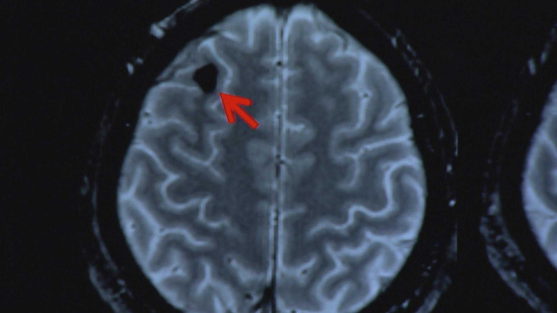 An MRI scan reveals a micro-bleed in the brain of a concussion patient. Image courtesy of Blake McHugh for KQED Science