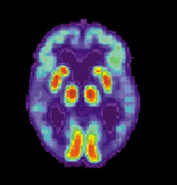 A no answer for Alzheimer's on a 23andMe test does not mean you are not at a higher risk for the disease.  This image of an Alzheimer brain courtesy of Wikimedia Commons. 