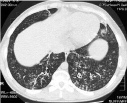 23andMe is very good at predicting simple genetic diseases like cystic fibrosis.  This image of the lung of a patient with CF courtesy of Wikimedia Commons.