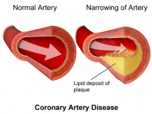 Athlerosclerosis, the formation of yellowish plaque made mostly of cholesterol inside artery walls. blocks blood flow and can lead to cardiac arrest. (Blausen/Wikipedia)