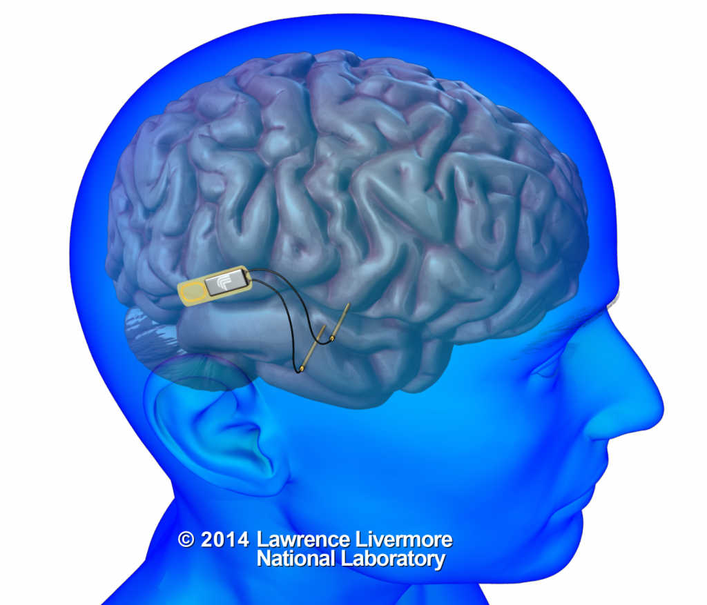 Researchers at Lawrence Livermore National Lab will develop an implantable device that will use electrical signals to communicate with individual neurons in the brain. UCLA scientists will use the device to study and repair memory function in brain trauma patients. (Courtesy of LLNL)