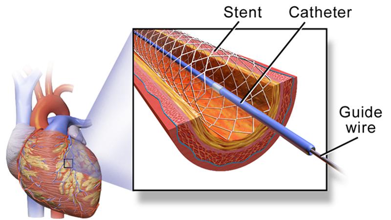 Stent in human coronary artery. (Wikimedia, Blausen gallery 2014) 