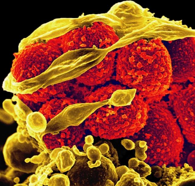 This scanning electron micrograph shows MRSA, methicillin-resistant Staphylococcus aureus bacteria (the yellow, round items), killing and escaping from a human white cell. 