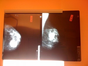 Suspicious mass on mammogram. (KristieWells: Flickr)