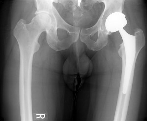 X-ray showing a new artificial hip. No, I don't know how much the patient paid for it. (okadots/Flickr)