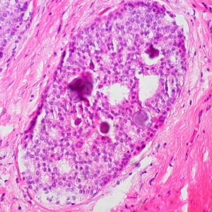 Ductal carcinoma in situ seen under a microscope. While doctors also call it Stage 0 Breast Cancer, in an article Monday, doctors argue it should no longer be labelled "cancer." (Ed Euthman/Flickr)