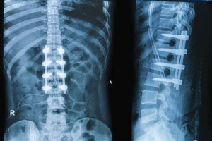 During spinal fusion surgery, doctors implant screws into the vertebrae of patients with devastating back injuries. (Praisaeng/Shutterstock)