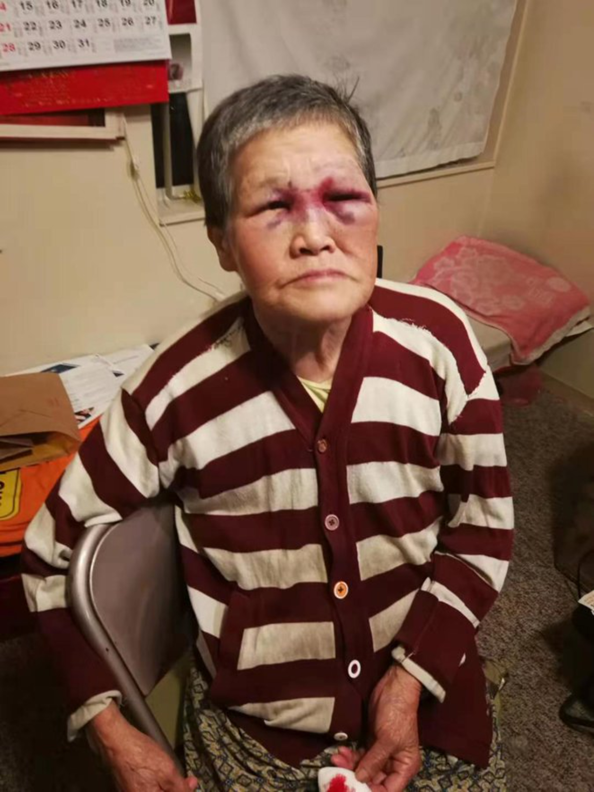 A senior woman, who is Asian, poses for a photo in a red and white striped shirt, she has an injured eye and face.