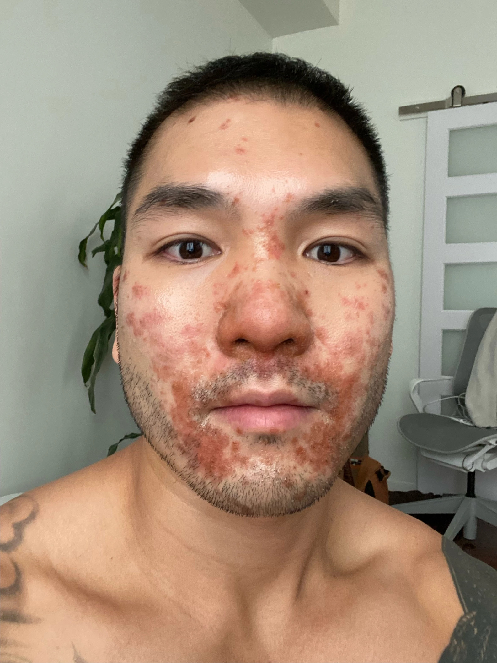 Houston man with monkeypox on face believes a kiss caused it