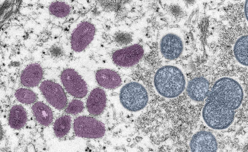 Digitally colorized electron microscopic (EM) image depicting an MPX virion (virus particle). Smith Collection/Gado/Getty Images