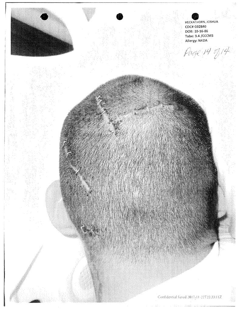 a medical record photo showing the back of a man's head with staples