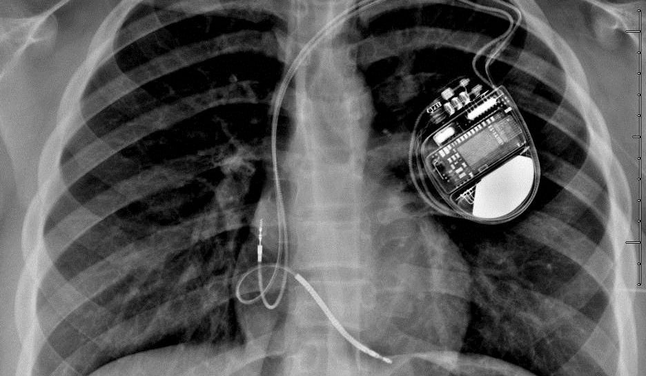 Pacemakers with a wireless function transmit patient data to physicians via the Internet, and that connection isn't always secure.
 University of Rochester Medical Center