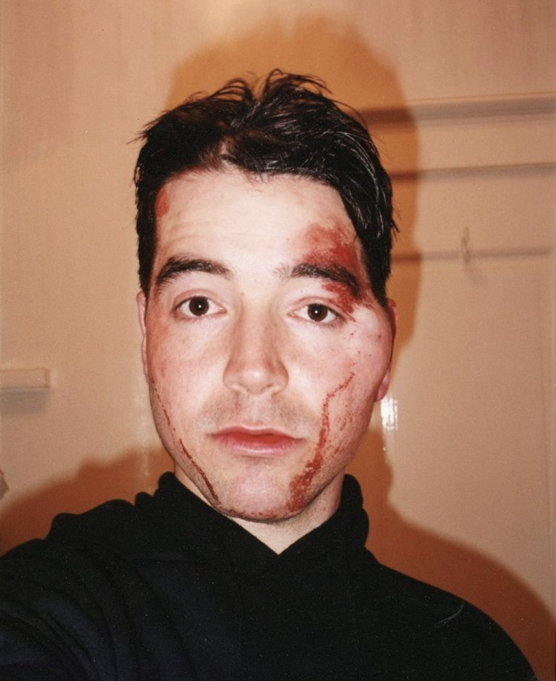 A young man with blood on his forehead and cheek, with a large lump forming on the side of his face, looks blankly at the camera. 