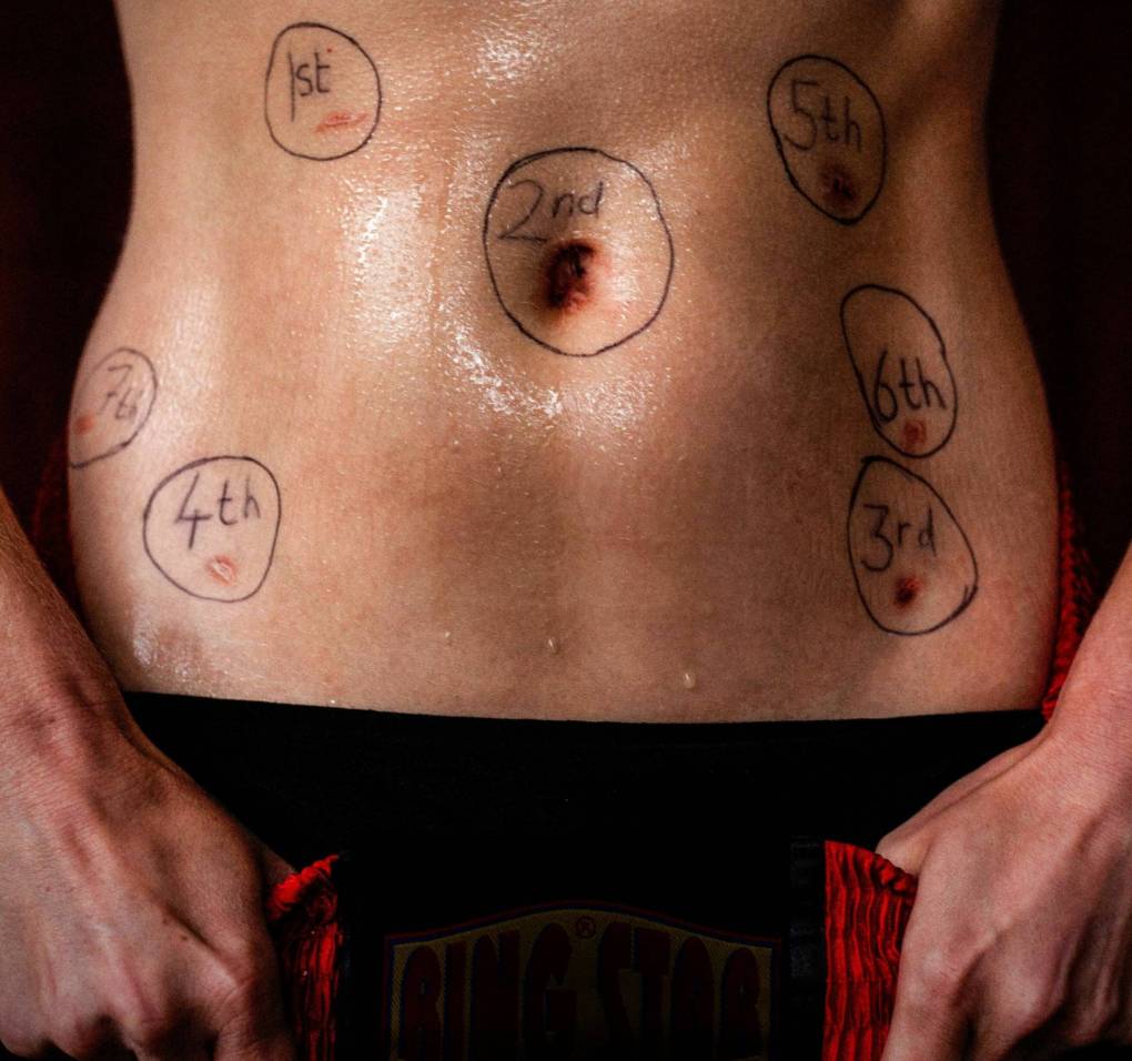 The sweat drenched torso of a woman is viewed in close up, with seven lesions visible around the belly button. Each is circled and numbered.