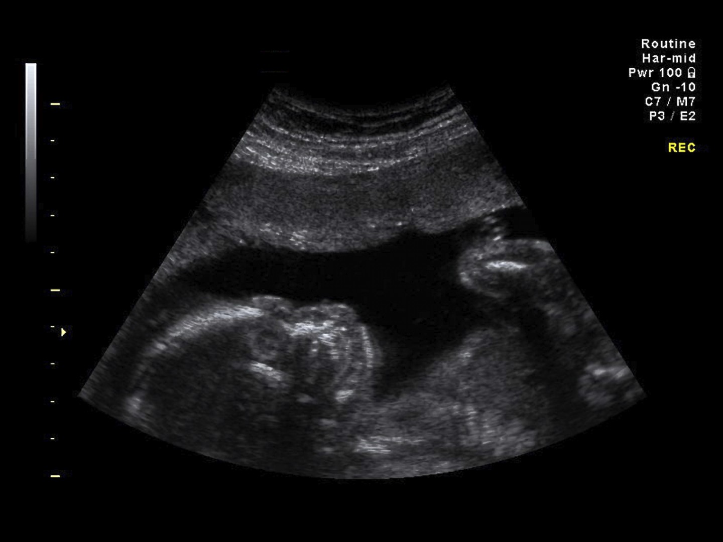 Prenatal Test: Ultrasound 