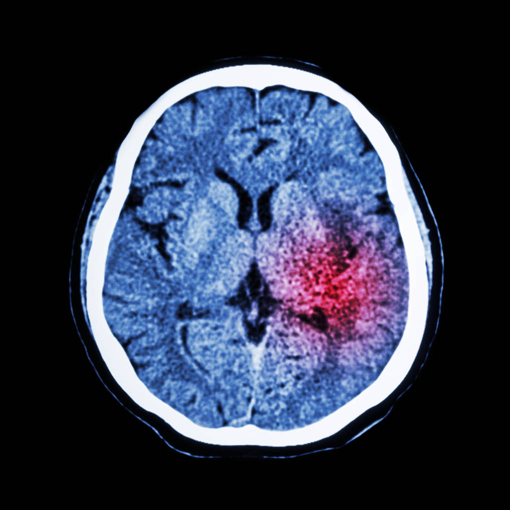 Top view of a brain showing a red blotch amid blue brain tissue